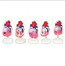 THE MODEL OF CONGENITAL HUMAN HEART DEFORMITY (SET OF 5)