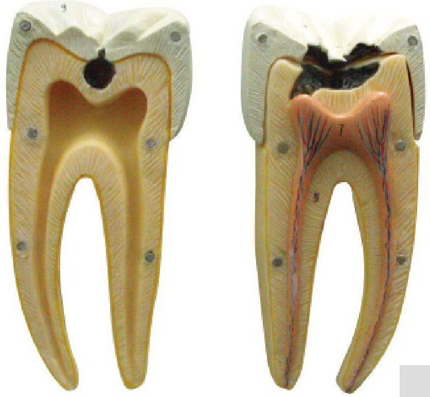 DENTAL CARIES MODEL
