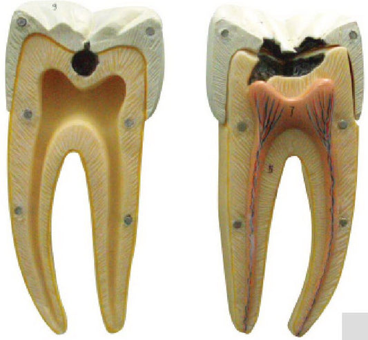 DENTAL CARIES MODEL