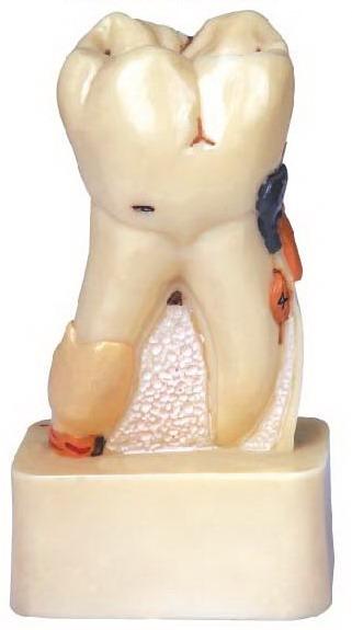 DISSECTED MODEL OF DENTAL DISEAS