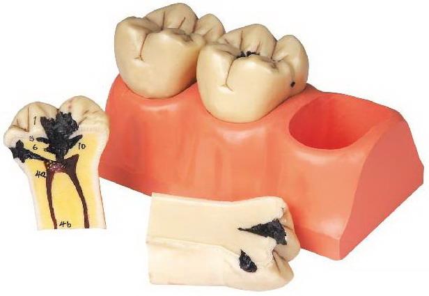 DISSECTED MODEL OF DENTAL CARIES